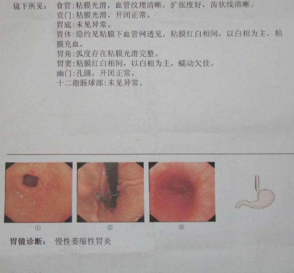 做完胃镜,拿到结果后非常担心,因为他们的检查结果是:慢性萎缩性胃炎