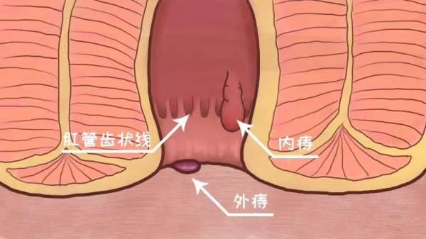 九华痔疮栓快速止血看得见!